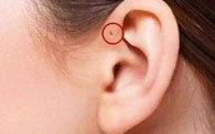 耳前瘘管有哪些症状表现?